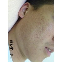 痤疮疤痕存在的诱因