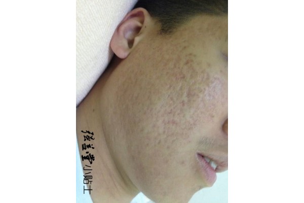 痤疮疤痕存在的诱因