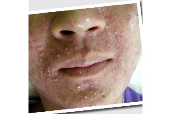 痘痘的部位说明你的身体问题