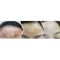 引发痘痘的四大原因