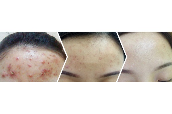 引发痘痘的四大原因