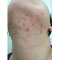  痤疮患者应该注意的饮食 :