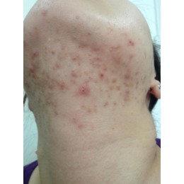  痤疮患者应该注意的饮食 :