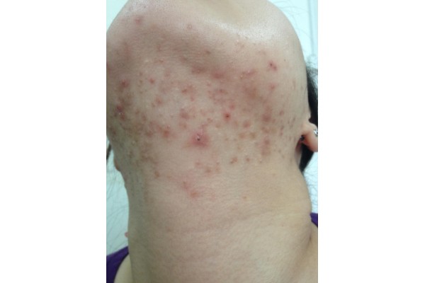  痤疮患者应该注意的饮食 :