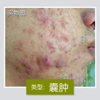 “激素脸”有什么治疗方法呢？