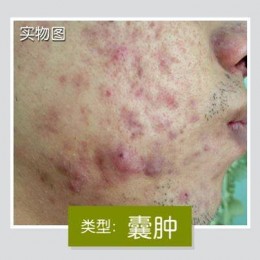 “激素脸”有什么治疗方法呢？