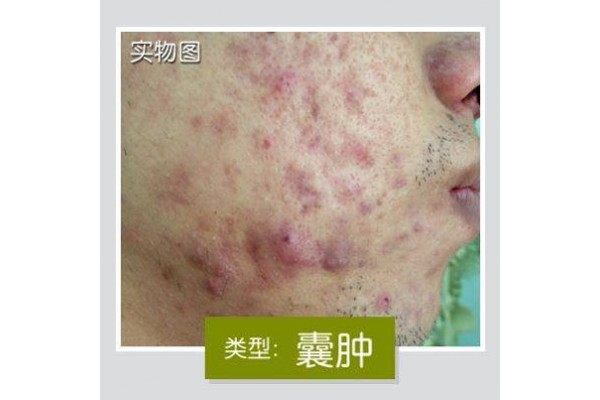 “激素脸”有什么治疗方法呢？
