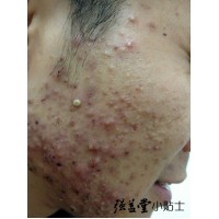 青春痘的护肤要点