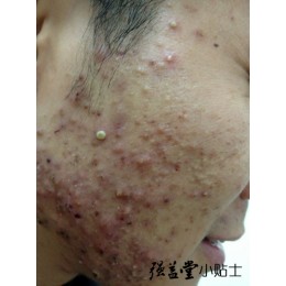 青春痘的护肤要点