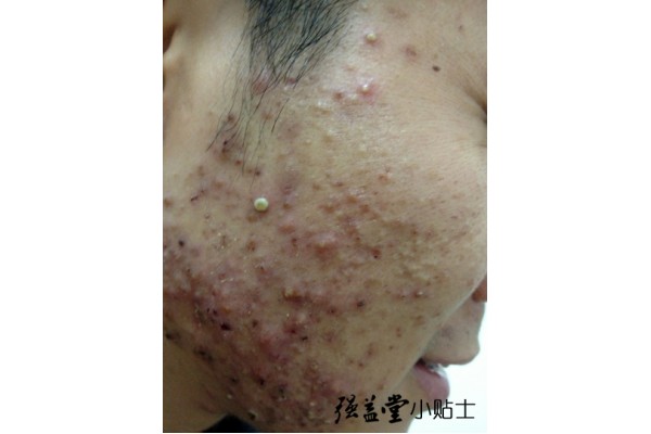 青春痘的护肤要点