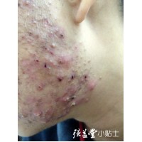 预防青春痘的十大注意事项