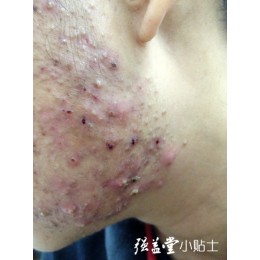 预防青春痘的十大注意事项