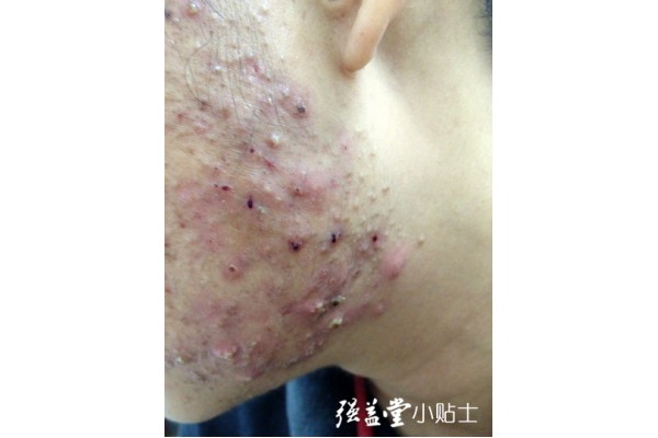 预防青春痘的十大注意事项