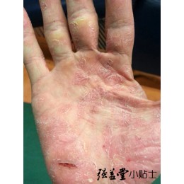 适合牛皮癣的一些水果蔬菜