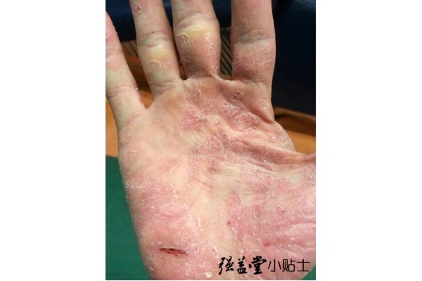 适合牛皮癣的一些水果蔬菜