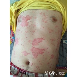 表毒外出以开腠理是治疗牛皮癣的关键