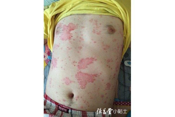 表毒外出以开腠理是治疗牛皮癣的关键